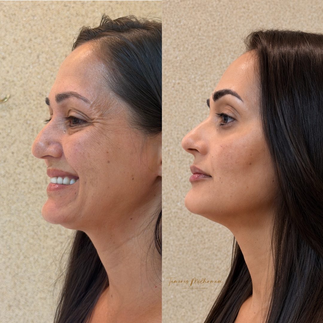 Harmonização Facial