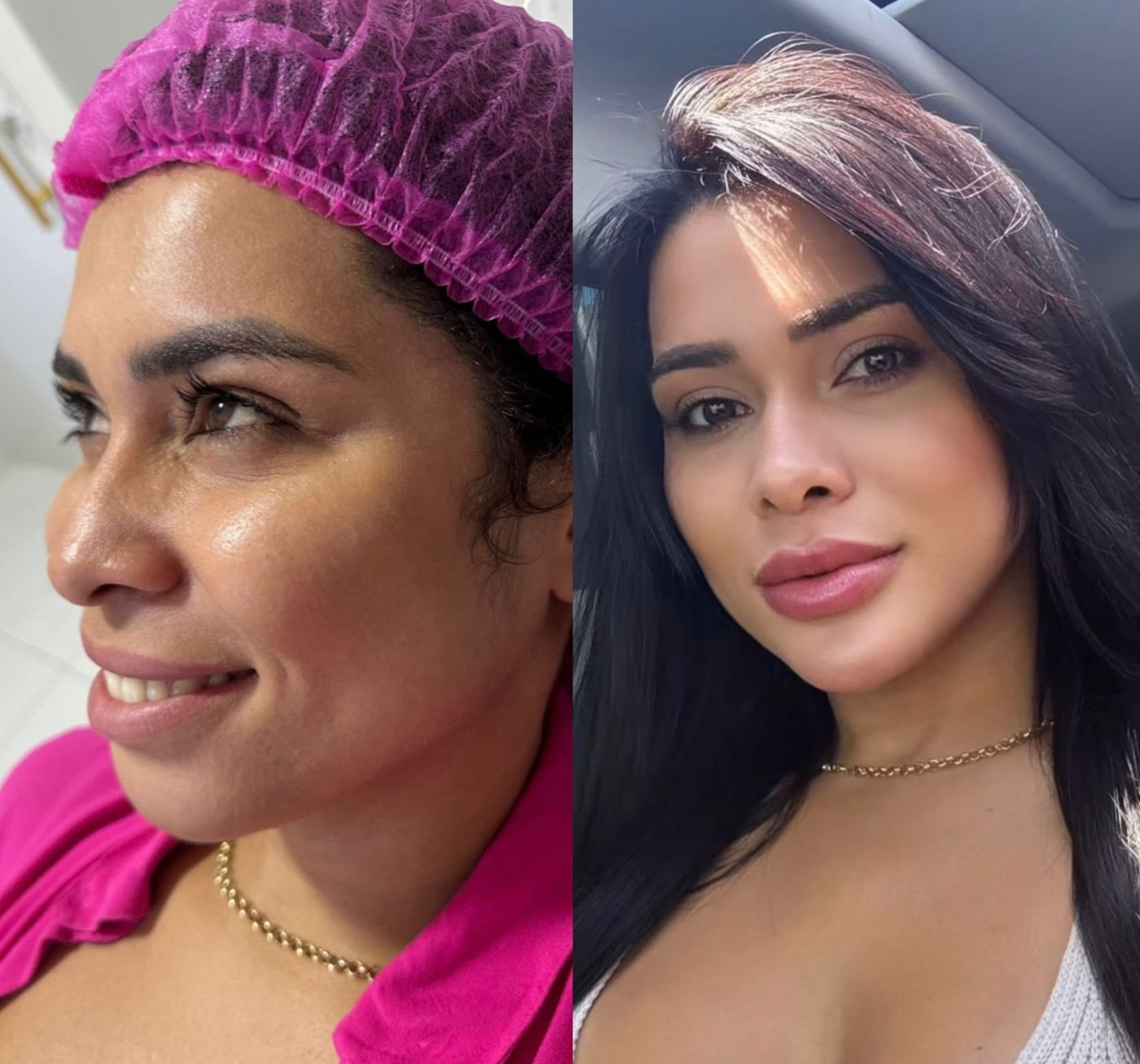 Perfiloplastia