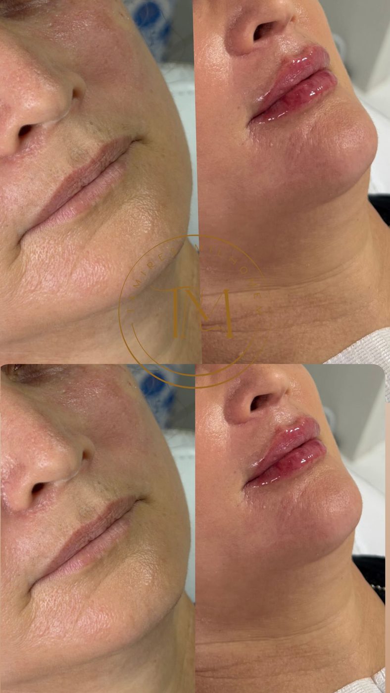 Preenchimento Labial