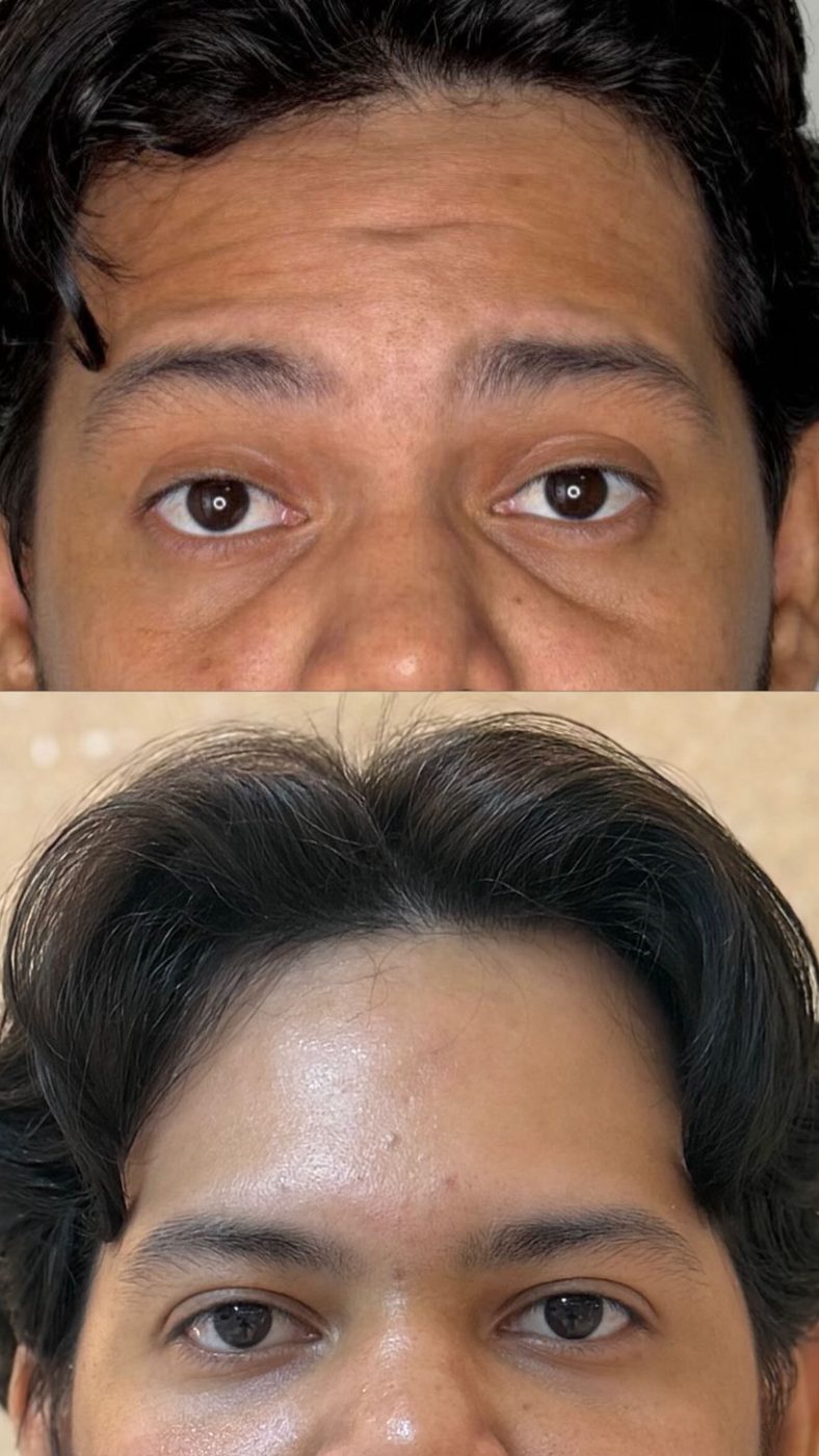 Tratamento de Olheiras