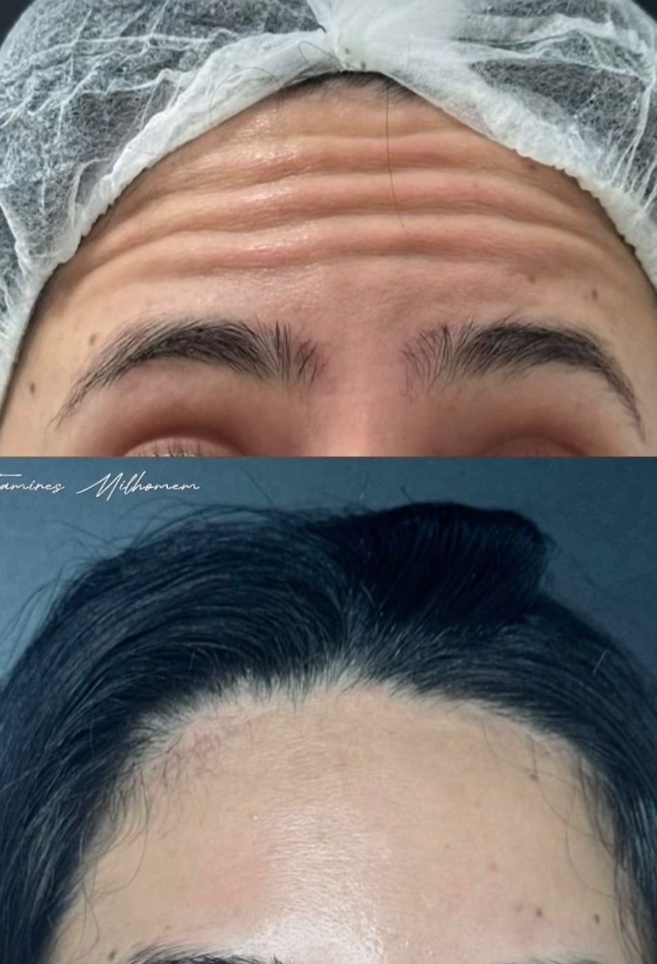 Toxina Botulínica