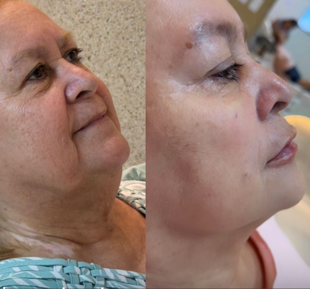 Resultado de Bioestimulador de Colágeno — antes e depois