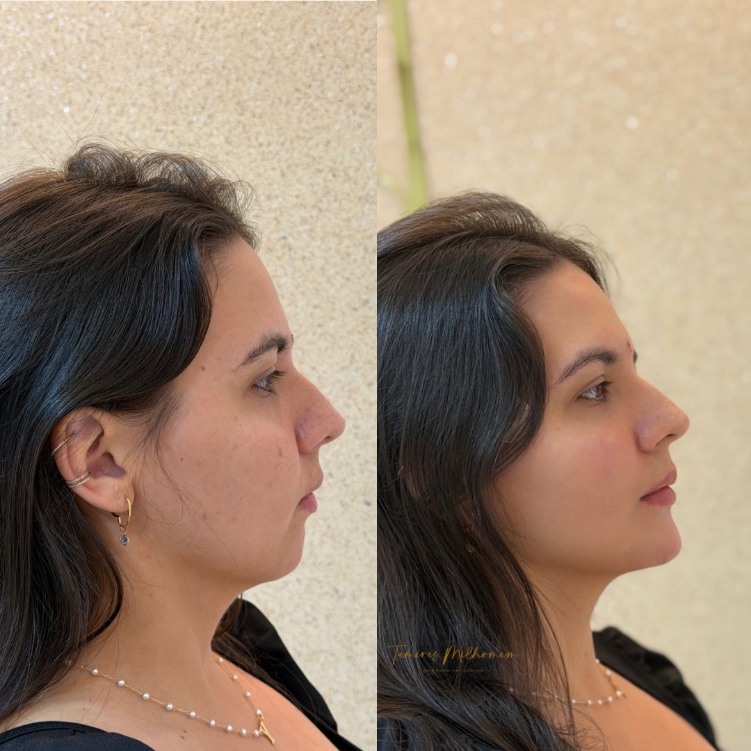 Resultado de Full Face — antes e depois