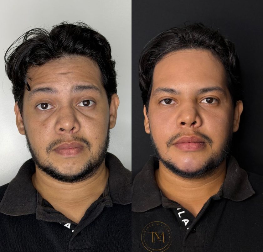 Resultado de Tratamento de Olheiras — antes e depois