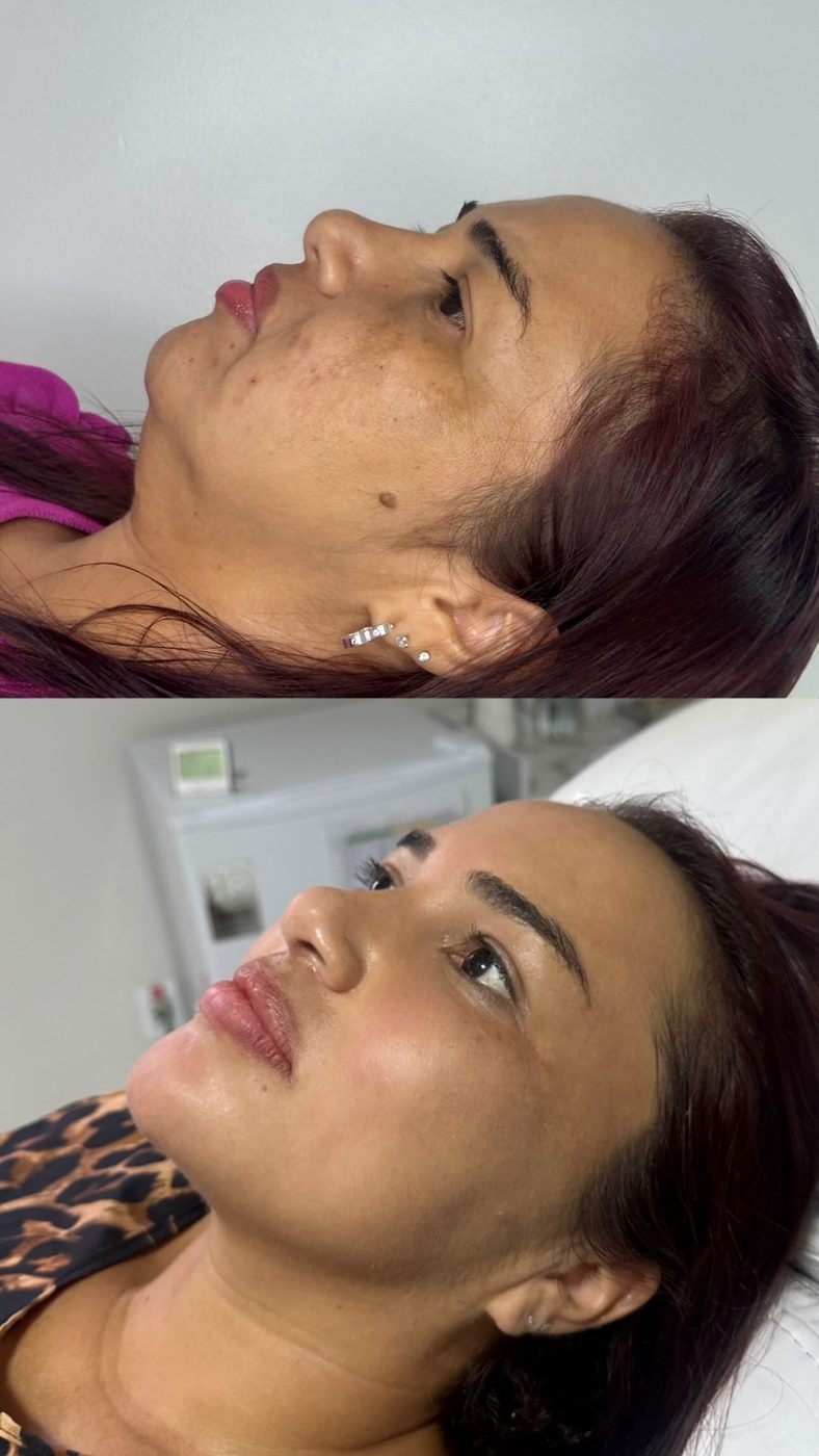 Resultado de Perfiloplastia — antes e depois