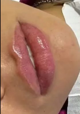 Resultado de Preenchimento Labial — antes e depois